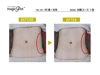 ルルン(LuLuN)/ラジオ波痩身お腹