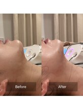 アラマンダ(Allamanda)/あご下BeforeAfter