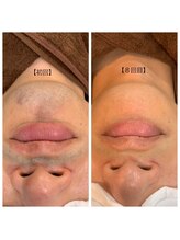 ケイ(Kei)/男性☆ひげ脱毛before /after 