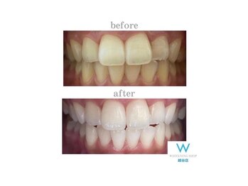 ホワイトニングショップ 越谷店/before&after美白ホワイトニング