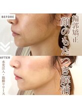 マヴィ 香里園店(MavY.)/ノンニードル水光注入