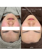 タグ 高知駅前店(Tug)/【頬の赤み・毛穴】