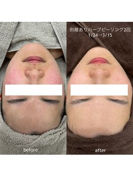 タグ 高知駅前店(Tug)/【頬の赤み・毛穴】