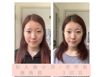 エクラ(Eclat)/小顔+肌質改善+たるみケア専門