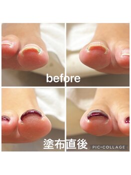 ミイア 春日部店(MiiA)/巻き爪改善ジェル　初回¥8,800