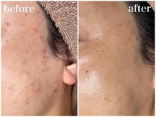 ホワイトアクア 梅田本店(WHITE AQUA)/ララピールでニキビケア/梅田