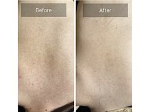 ルナート(Lunart)/ハーブピーリング【背中】