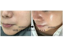 メディカルサロンドオフ 堺東店(medical salon de off)/LEZE(ルゼ)カクテルピーリング