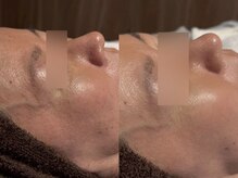 アンティアージュ 福岡本店(antiage)/気になる毛穴の悩みに