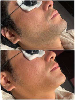 グロー(GLOW)/メンズヒゲ脱毛