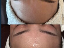 ジョーヌ(JAUNE)/質感改善で光を放つおでこへ