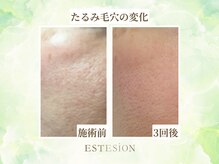 エステシオン(ESTESiON)/たるみ毛穴の変化