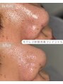 ルコル(LUCOL) 敏感肌OKの毛穴洗浄でツルツル肌を目指しませんか?池袋西口