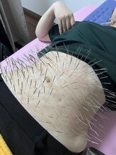 はりひろし鍼灸院/運気が上がるお腹の鍼