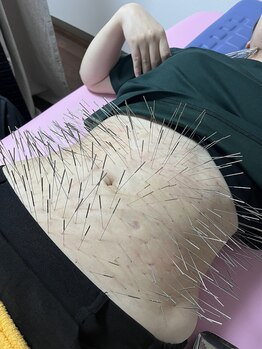 はりひろし鍼灸院/運気が上がるお腹の鍼