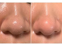 エステ リラクゼーションサロン(more)の雰囲気（【毛穴洗浄】夏の小鼻黒ずみ・毛穴スッキリ！メンズも可◎）