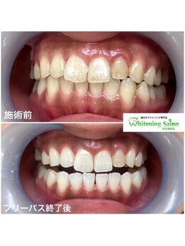 ホワイトニングサロン 名古屋駅店/【ホワイトニング施術例】