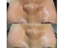 フロラスキン 心斎橋店(florasKIN)/誰もが憧れる韓国人のような艶肌