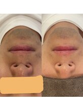 スリーズララ(Cerise LaLa)/ヒゲ脱毛のbefore→after