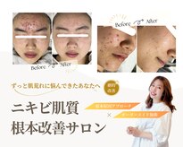 ミラリー(MIRALY)