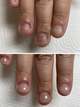 ココ ネイル サロン アンドスクール(COCO.NAIL SALON＆SCHOOL)の写真/長年の爪噛み・深爪でお悩みの方へ★お爪のトラブルはお任せ♪ケア方法もアドバイス◎何でもご相談下さい◇