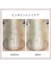 【結果重視☆プラズマシミケア】お試し5分！¥7,000→¥5,000