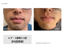 サロン リノ(salon rino)/光脱毛