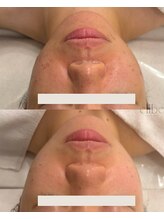 エルベ(ellbe)/肌質改善【ニキビケア、毛穴】