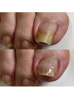 巻き爪矯正1回目(右親指)