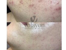 イヨヨ(iyoyo)/BeforeAfter