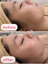 エン(O'en)/ハーブピーリング