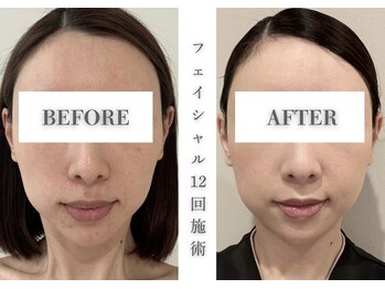 リアレント 高槻店(Lialent)/たるみもスッキリ♪