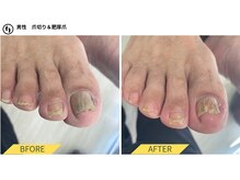 ふっとけ庵/肥厚爪ケア