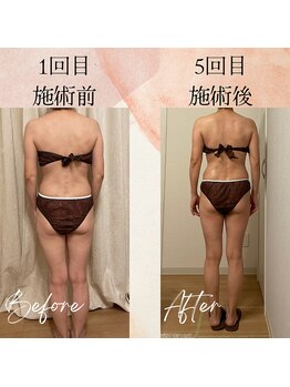 ラルーエ 仙台/全身筋膜痩身90分before→after
