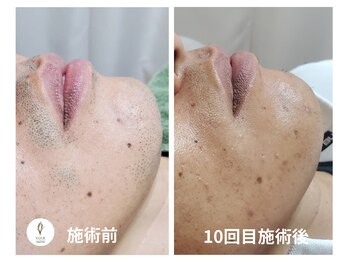 ヴォアール 名古屋店(VOIR)/ヒゲ脱毛10回目施術後