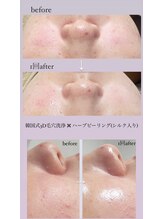 クレヴィー(Creviy)/ハーブピーリング×3D毛穴洗浄