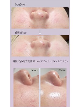 クレヴィー(Creviy)/ハーブピーリング×3D毛穴洗浄