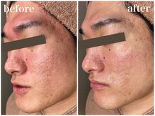 ホワイトアクア 梅田本店(WHITE AQUA)/ララピールで肌荒れ改善/梅田