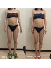 シレーヌ(Sirene)/ラジオ波/吸引/キャビテーション