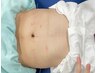 2回目以降【運動が苦手な方に】ダイエット鍼　1回 50分