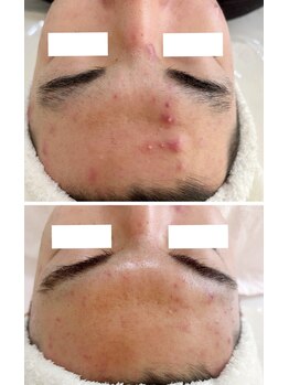 プリュボーテ(Pul Beaute)/凸凹肌やニキビケアに♪