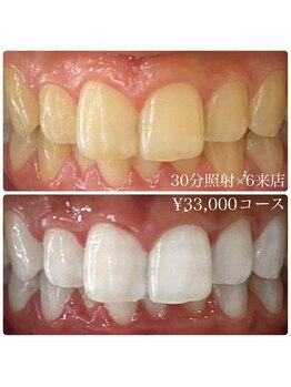 ホワイトニングルーム 横浜店(Whitening Room)/セルフホワイトニング/横浜