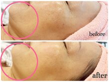 シルク(Cilk)/小顔たるみ美白1回の施術で変化