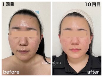 ダルセーニョ/「美人メンタル」はコルギから！