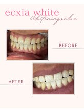 エクシアホワイトニング 奥田店/ホワイトニングビフォーアフター