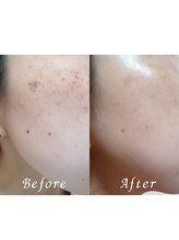 ララリア(LaLaLia)/光フェイシャル