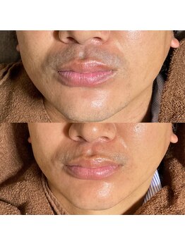 リラチル(relachill)/ヒゲ脱毛