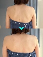 ミルキー(Milky)/お背中の膨らみ、体の歪みを改善