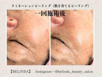 ベリンダ(BELINDA)/ラミネーションピーリング(肌育)
