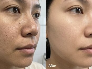 コスメティック雅の写真/気温と湿度が高くなると毛穴の汚れが詰まりやすくなります。すっきり大掃除しましょう。